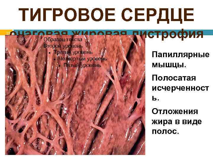 ТИГРОВОЕ СЕРДЦЕ очаговаятекста жировая дистрофия Образец Второй уровень миокарда Папиллярные Третий уровень 25 Четвертый