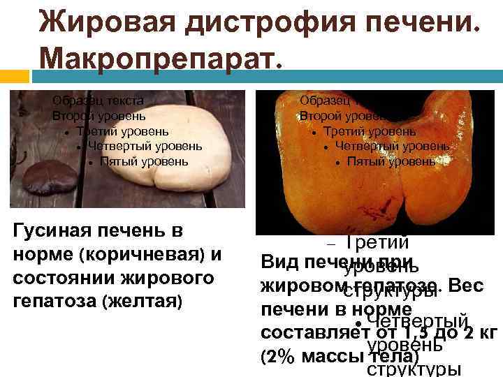 Жировая дистрофия печени. Макропрепарат. Образец текста Второй уровень Третий уровень Четвертый уровень Пятый уровень