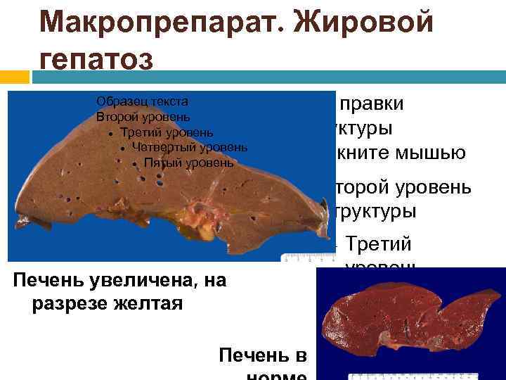 Макропрепарат. Жировой гепатоз Образец текста Второй уровень Третий уровень Четвертый уровень Пятый уровень Для
