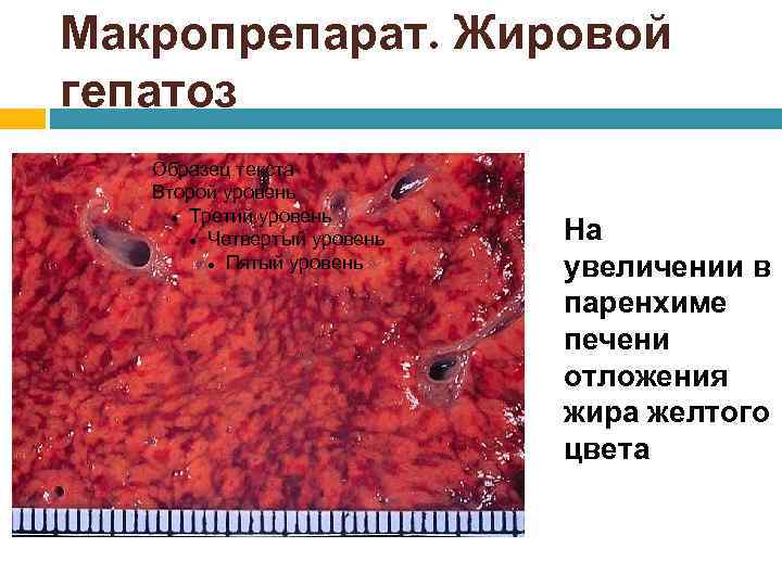 Макропрепарат. Жировой гепатоз Образец текста Второй уровень Третий уровень Четвертый уровень Пятый уровень На