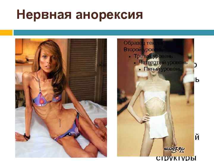 Нервная анорексия Для правки структуры щелкните мышью Образец текста Второй уровень Третий уровень Четвертый