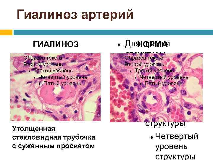 Гиалиноз артерий ГИАЛИНОЗ Образец текста Второй уровень Третий уровень Четвертый уровень Пятый уровень Для