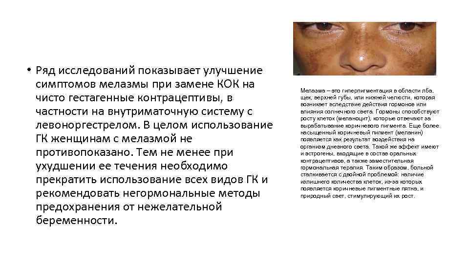  • Ряд исследований показывает улучшение симптомов мелазмы при замене КОК на чисто гестагенные