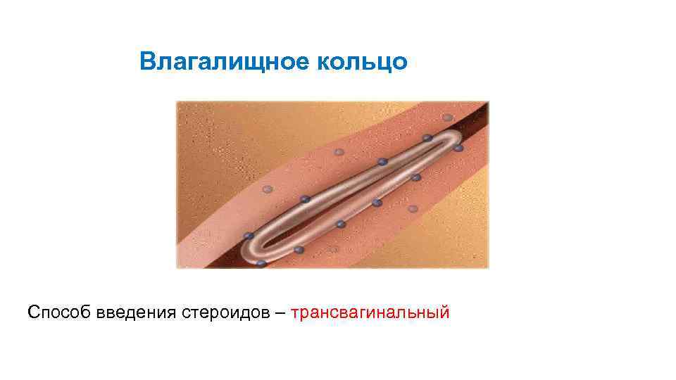 Влагалищное кольцо Способ введения стероидов – трансвагинальный 