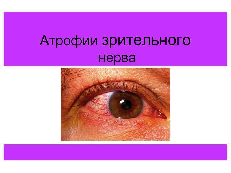 Атрофии зрительного нерва 
