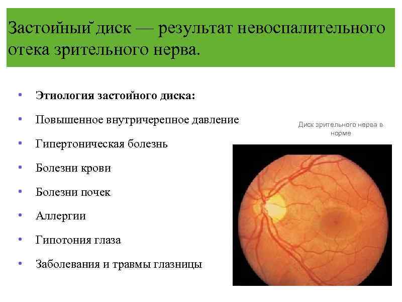 Застои ныи диск — результат невоспалительного отека зрительного нерва. • Этиология застои ного диска: