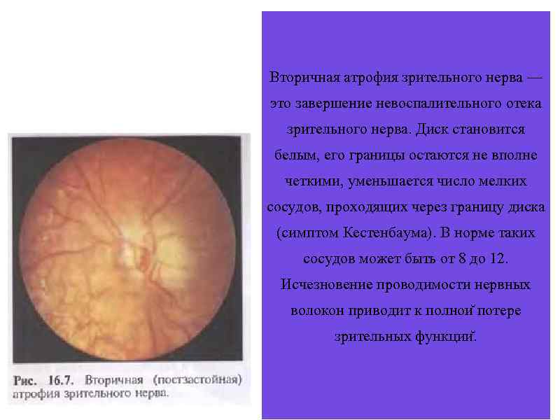 Атрофия зрительного нерва у детей