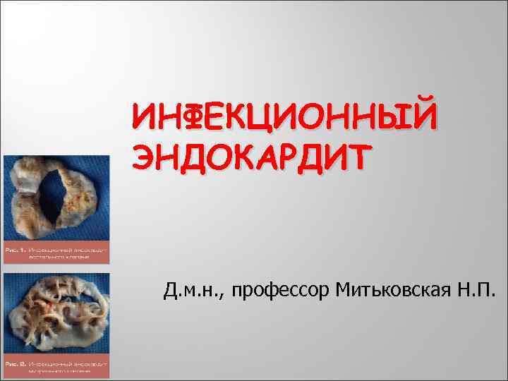 ИНФЕКЦИОННЫЙ ЭНДОКАРДИТ Д. м. н. , профессор Митьковская Н. П. 