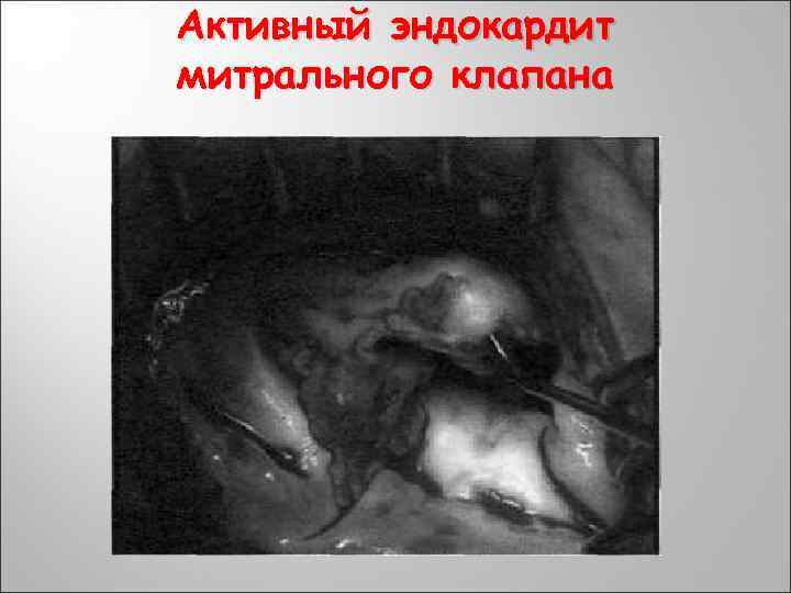 Активный эндокардит митрального клапана 