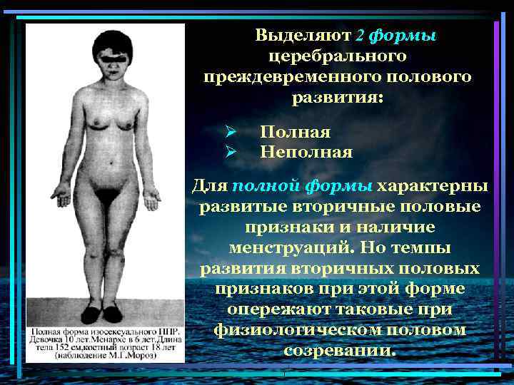 Выделяют 2 формы церебрального преждевременного полового развития: Ø Ø Полная Неполная Для полной формы
