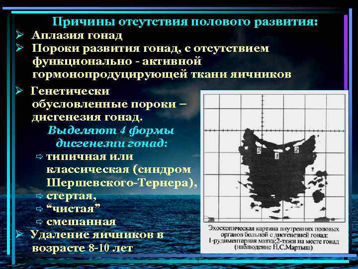 Ø Ø Причины отсутствия полового развития: Аплазия гонад Пороки развития гонад, с отсутствием функционально