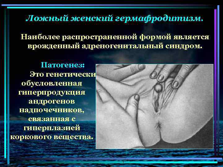 Ложный женский гермафродитизм. Наиболее распространенной формой является врожденный адреногенитальный синдром. Патогенез: Это генетически обусловленная