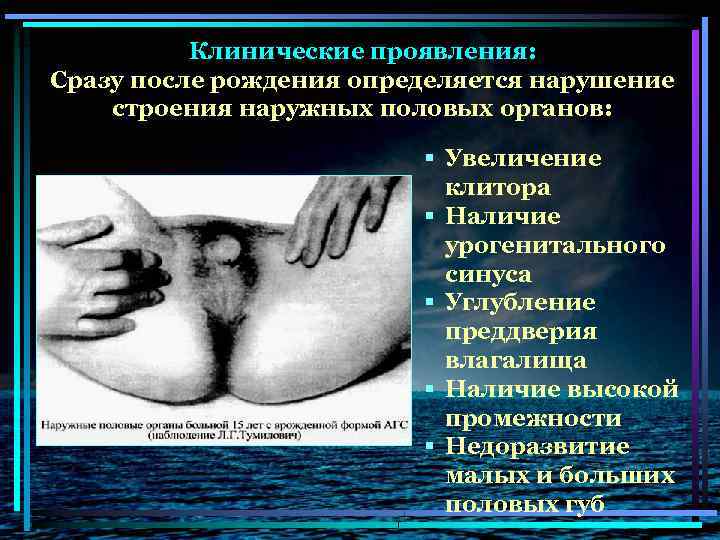 Клинические проявления: Сразу после рождения определяется нарушение строения наружных половых органов: § Увеличение клитора