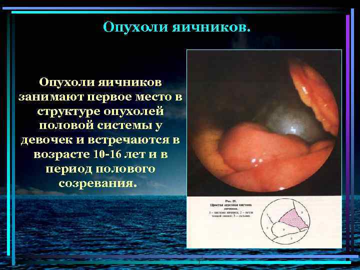 Опухоли яичников. Опухоли яичников занимают первое место в структуре опухолей половой системы у девочек