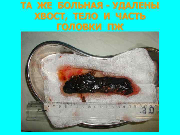 ТА ЖЕ БОЛЬНАЯ - УДАЛЕНЫ ХВОСТ, ТЕЛО И ЧАСТЬ ГОЛОВКИ ПЖ 