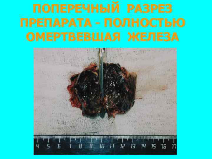 ПОПЕРЕЧНЫЙ РАЗРЕЗ ПРЕПАРАТА - ПОЛНОСТЬЮ ОМЕРТВЕВШАЯ ЖЕЛЕЗА 