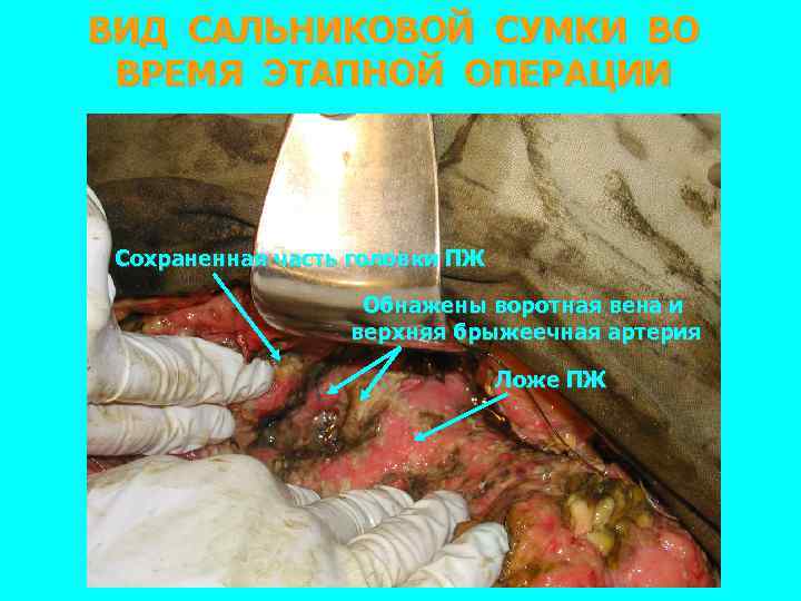 ВИД САЛЬНИКОВОЙ СУМКИ ВО ВРЕМЯ ЭТАПНОЙ ОПЕРАЦИИ Сохраненная часть головки ПЖ Обнажены воротная вена
