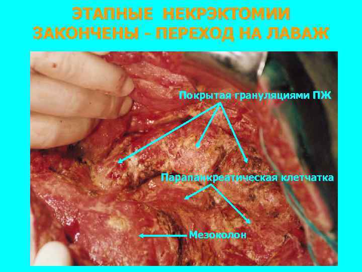 ЭТАПНЫЕ НЕКРЭКТОМИИ ЗАКОНЧЕНЫ - ПЕРЕХОД НА ЛАВАЖ Покрытая грануляциями ПЖ Парапанкреатическая клетчатка Мезоколон 