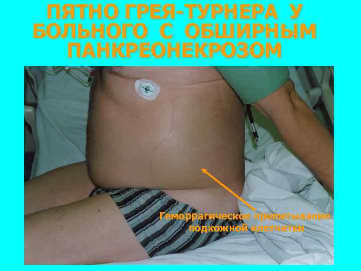 ПЯТНО ГРЕЯ-ТУРНЕРА У БОЛЬНОГО С ОБШИРНЫМ ПАНКРЕОНЕКРОЗОМ Геморрагическое пропитывание подкожной клетчатки 