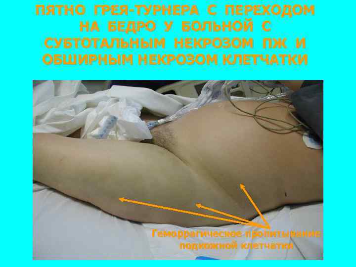 ПЯТНО ГРЕЯ-ТУРНЕРА С ПЕРЕХОДОМ НА БЕДРО У БОЛЬНОЙ С СУБТОТАЛЬНЫМ НЕКРОЗОМ ПЖ И ОБШИРНЫМ