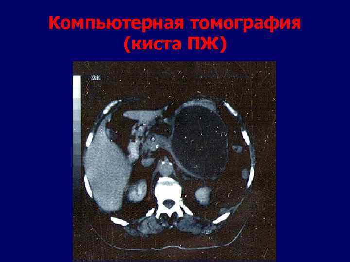 Компьютерная томография (киста ПЖ) 