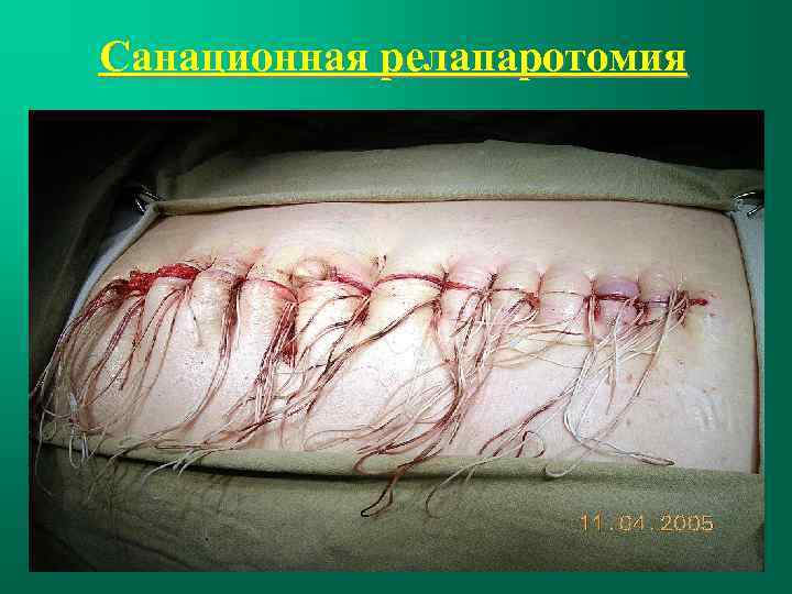 Санационная релапаротомия 