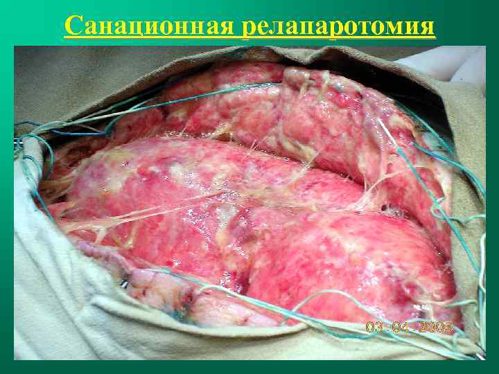 Санационная релапаротомия 