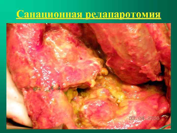 Санационная релапаротомия 