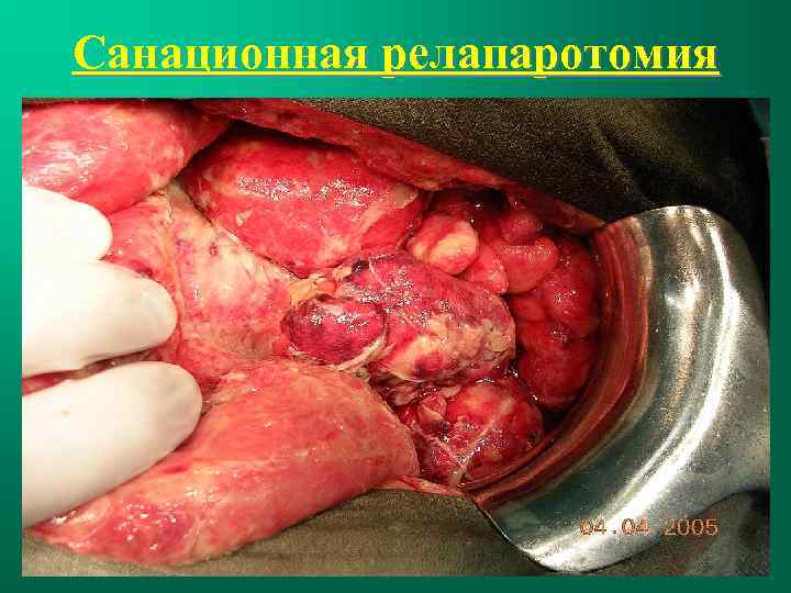 Санационная релапаротомия 