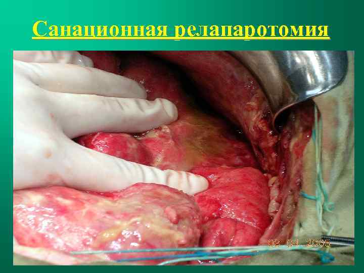 Санационная релапаротомия 