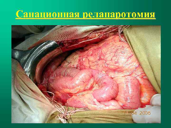 Санационная релапаротомия 