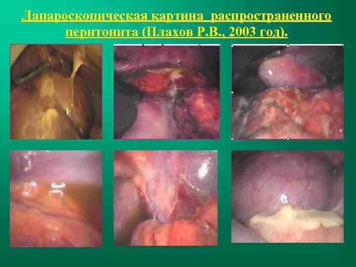 Лапароскопическая картина распространенного перитонита (Плахов Р. В. , 2003 год). 