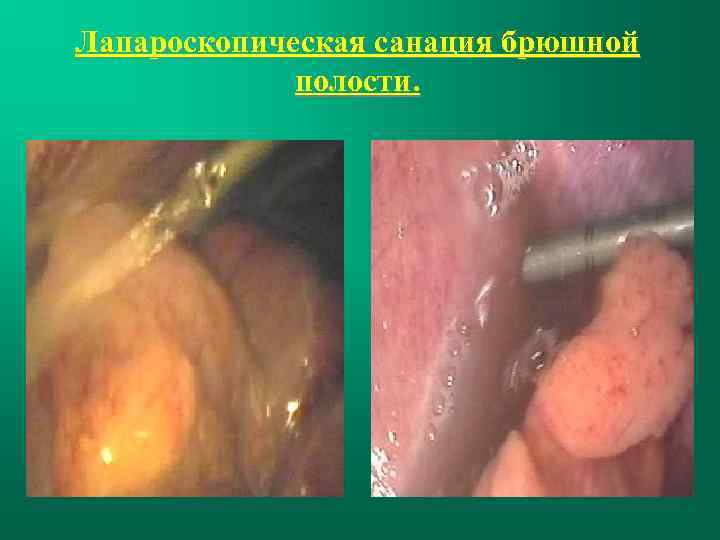 Лапароскопическая санация брюшной полости. 