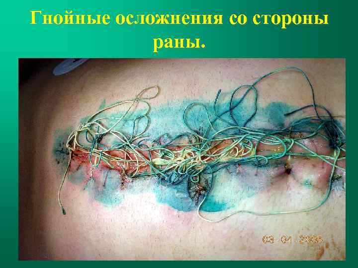 Гнойные осложнения со стороны раны. 