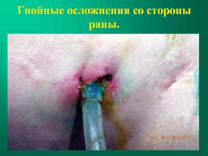 Гнойные осложнения со стороны раны. 