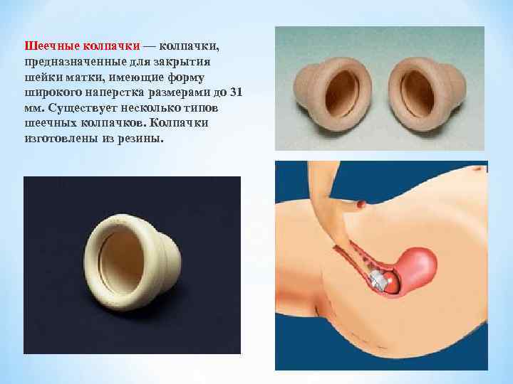 Шеечные колпачки — колпачки, предназначенные для закрытия шейки матки, имеющие форму широкого наперстка размерами