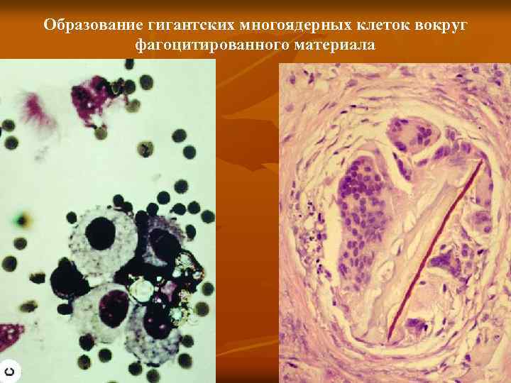 Образование гигантских многоядерных клеток вокруг фагоцитированного материала 