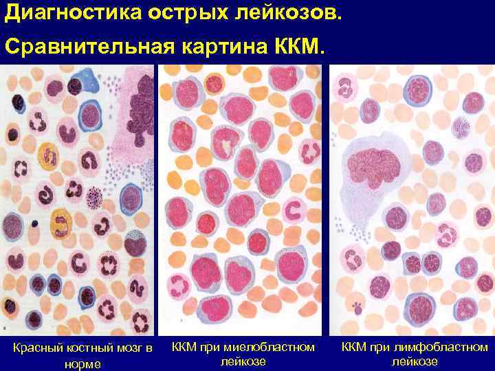 Картина крови при миелобластном лейкозе остром