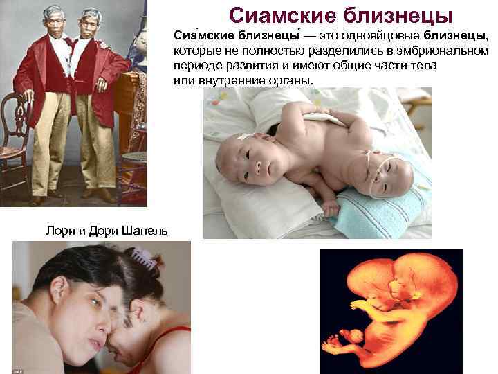 Сиамские близнецы Сиа мские близнецы — это однояйцовые близнецы, которые не полностью разделились в