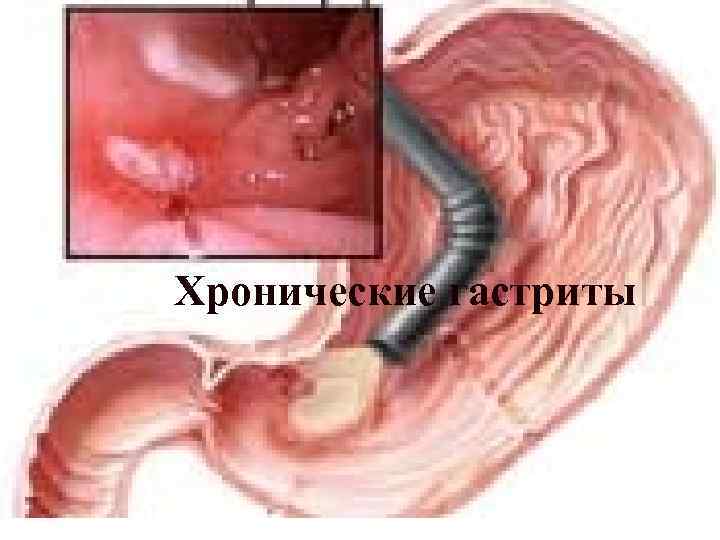 Хронические гастриты 