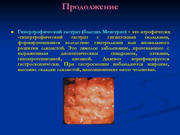Продолжение n Гипертрофический гастрит (болезнь Менетрие) – это атрофически -гипертрофический гастрит с гигантскими складками,