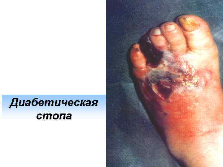 Диабетическая стопа 