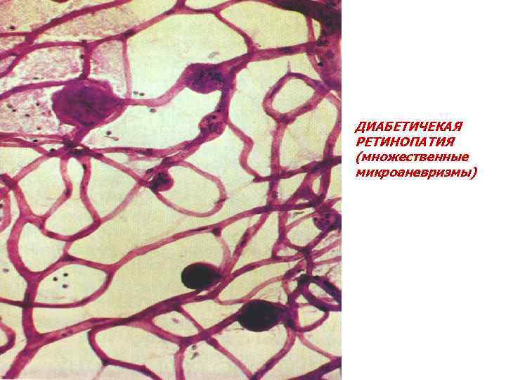 ДИАБЕТИЧЕКАЯ РЕТИНОПАТИЯ (множественные микроаневризмы) 