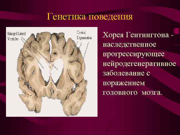 Генетика поведения Хорея Гентингтона наследственное прогрессирующее нейродегенеративное заболевание с поражением головного мозга. 