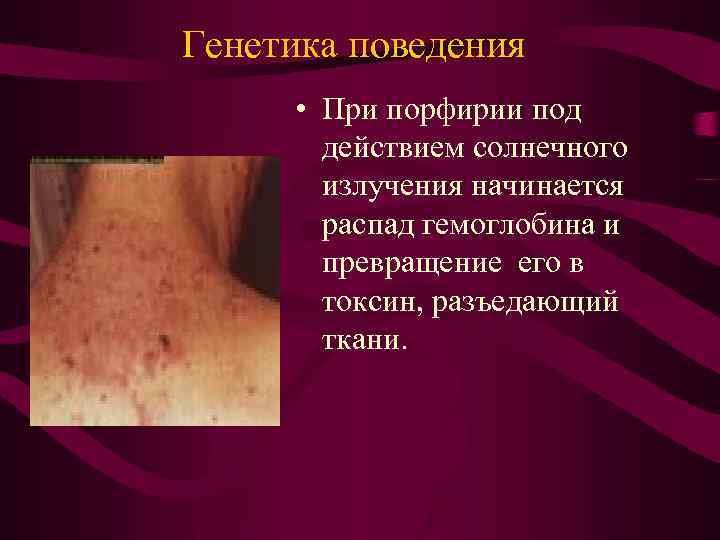 Генетика поведения • При порфирии под действием солнечного излучения начинается распад гемоглобина и превращение