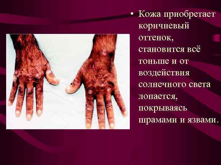  • Кожа приобретает коричневый оттенок, становится всё тоньше и от воздействия солнечного света