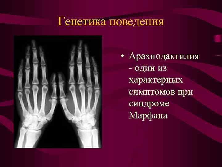 Генетика поведения • Арахнодактилия - один из характерных симптомов при синдроме Марфана 