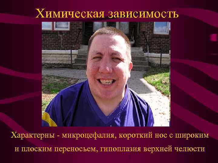 Химическая зависимость Характерны - микроцефалия, короткий нос с широким и плоским переносьем, гипоплазия верхней