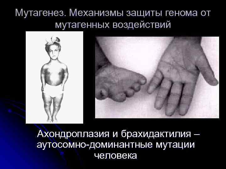 Мутагенез. Механизмы защиты генома от мутагенных воздействий Ахондроплазия и брахидактилия – аутосомно-доминантные мутации человека