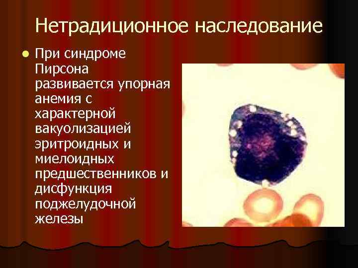 Нетрадиционное наследование l При синдроме Пирсона развивается упорная анемия с характерной вакуолизацией эритроидных и